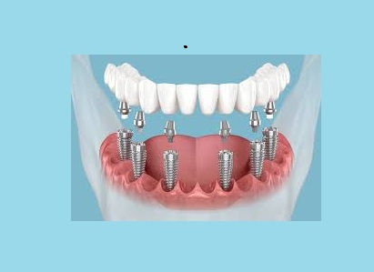 Dr Care Dental Hospitals Full Mouth Fixed Teeth With Dental Implants In Boduppal, Hyderabad-https://i-media.vyaparify.com/vcards/products/312394/product_1775494108_69d3e3dc473c3.jpeg Image