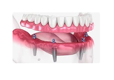 Dr Care Dental Hospitals Full Mouth Fixed Teeth With Dental Implants In Peerzadiguda, Hyderabad-https://i-media.vyaparify.com/vcards/products/312395/product_1775494214_69d3e446ee169.jpeg Image