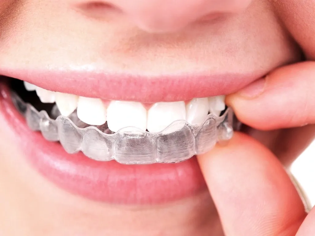 Affordable Aligners in Jaipur Smile Carve Dental Clinic & Facial Aesthetic Center Nandan Apartment, C 72 Sarojini Marg, C Scheme