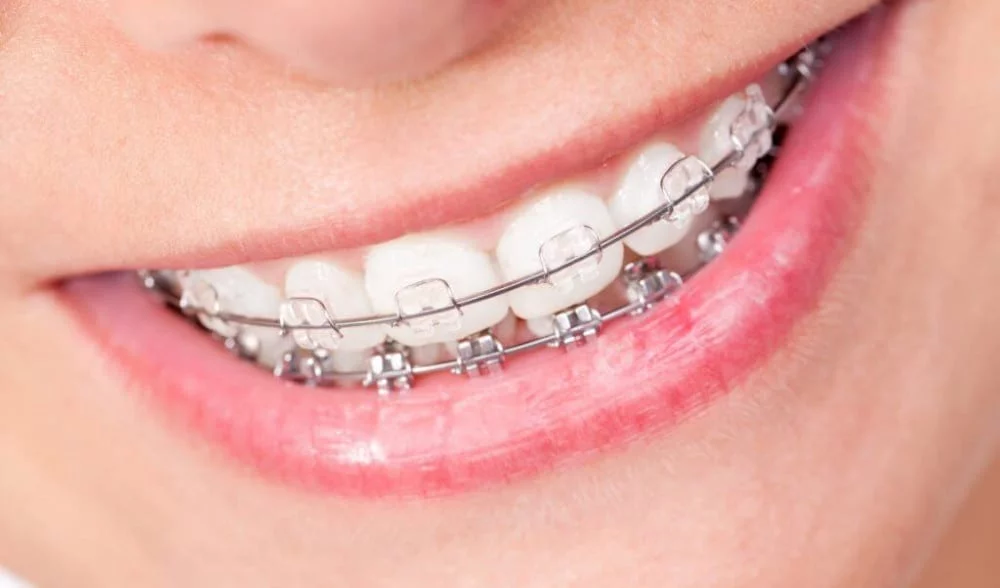 Advanced Metal and Ceramic Braces Smile Carve Dental Clinic & Facial Aesthetic Center Nandan Apartment, C 72 Sarojini Marg, C Scheme