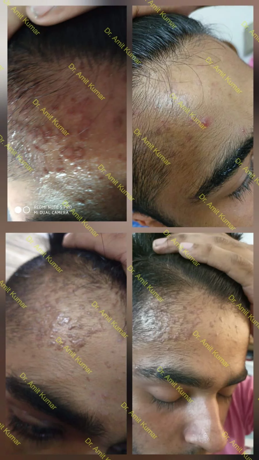 Homeopathic Treatment for Warts