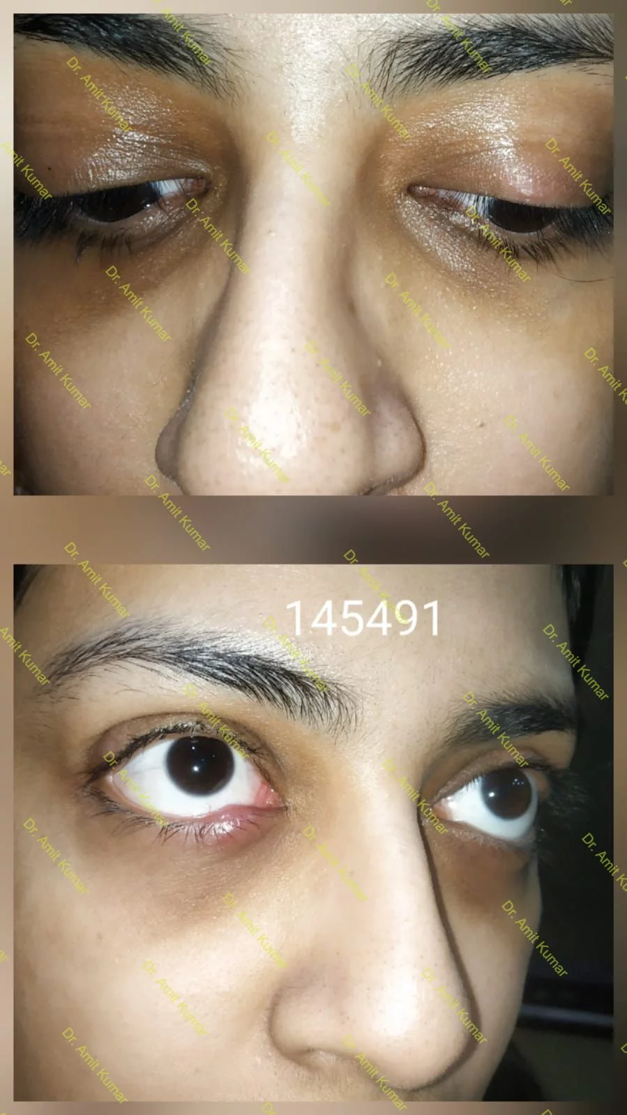 Homeopathic Treatment for Chalazion