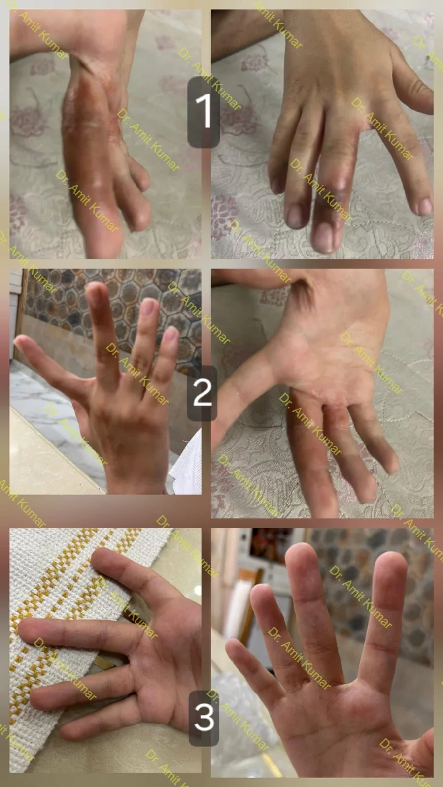 Homeopathic Treatment for Eczema