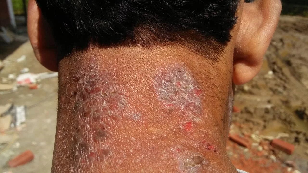 Homeopathic Treatment for Psoriasis