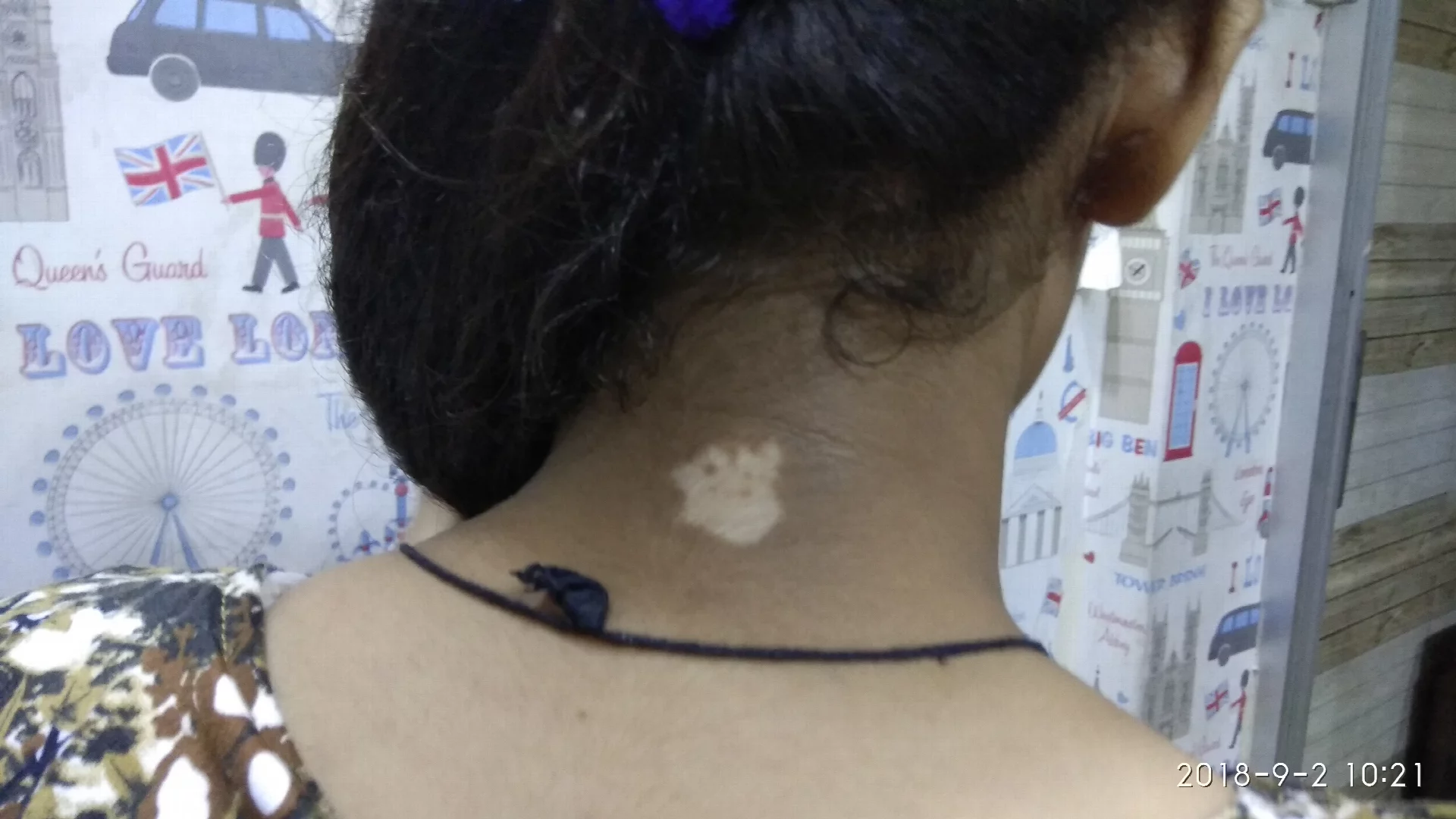 Homeopathic Treatment for Vitiligo