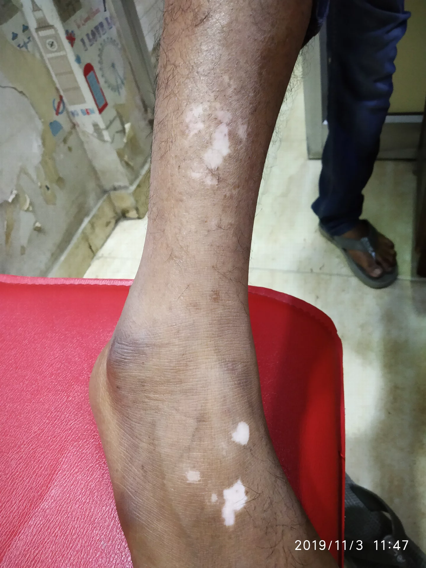 Homeopathic Treatment for Vitiligo