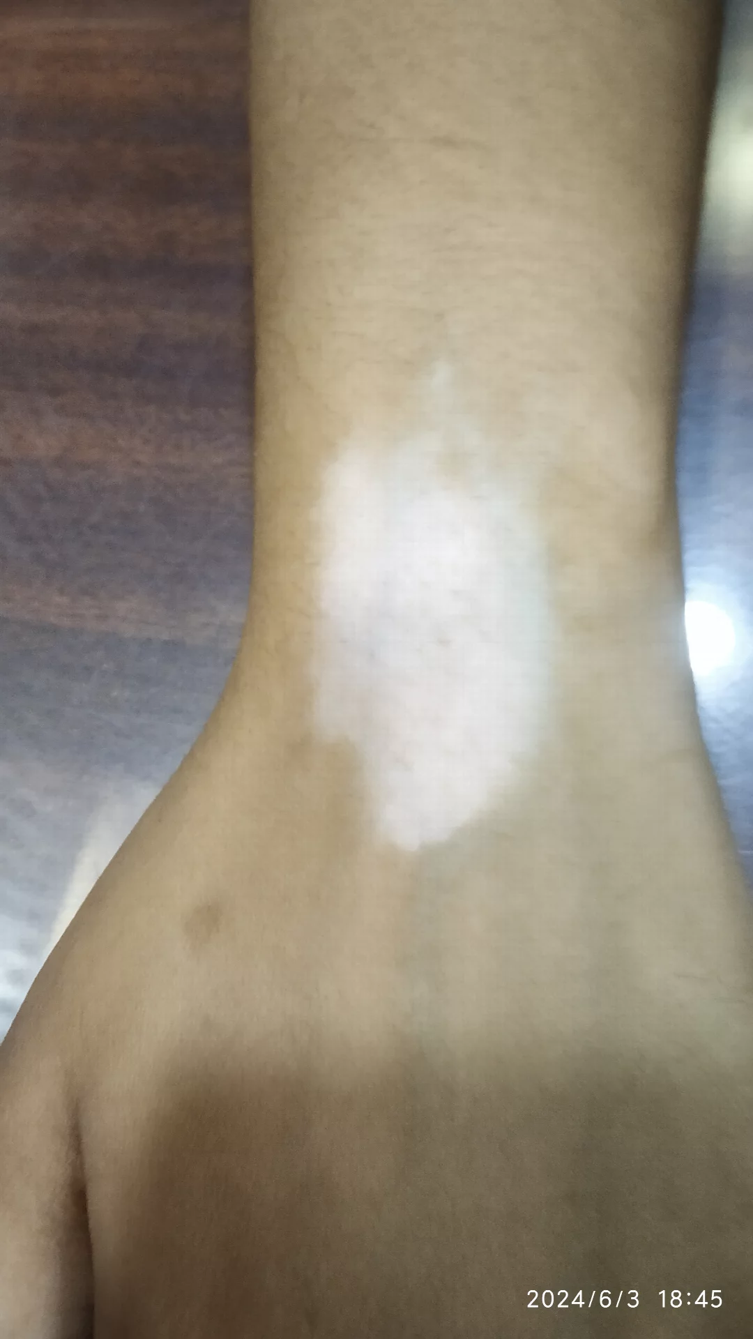 Homeopathic Treatment for Vitiligo