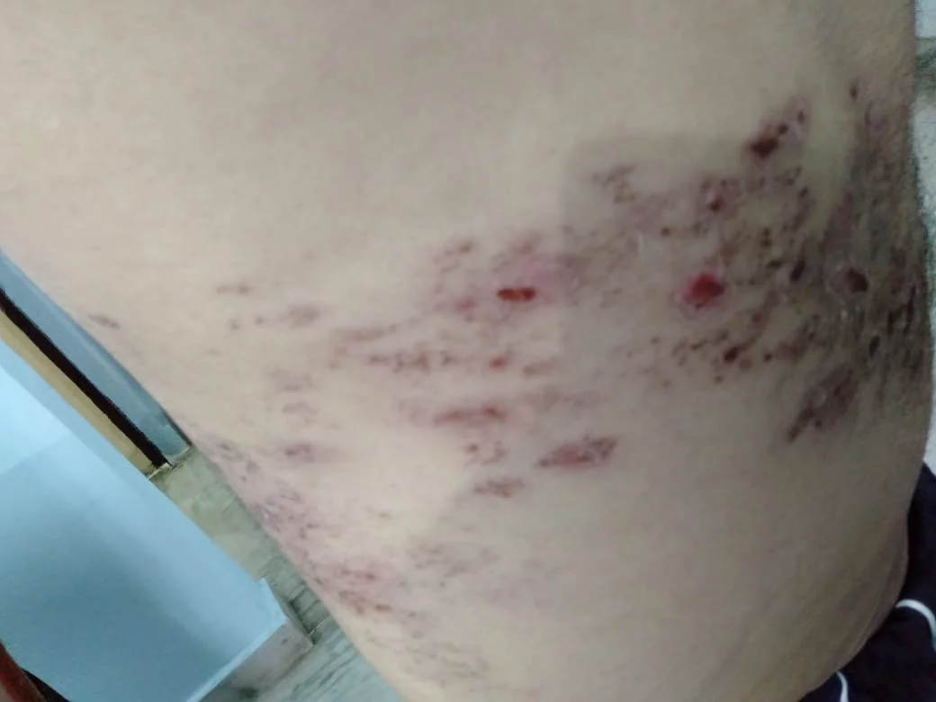 Homeopathic Treatment for Herpes