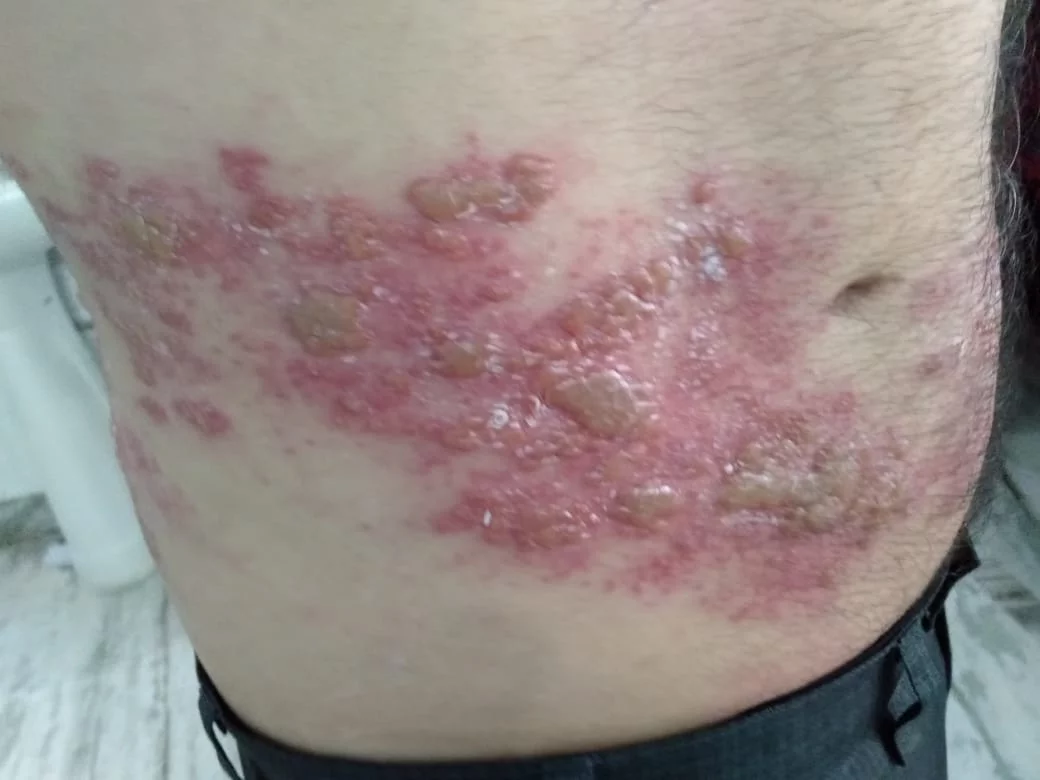 Homeopathic Treatment for Herpes