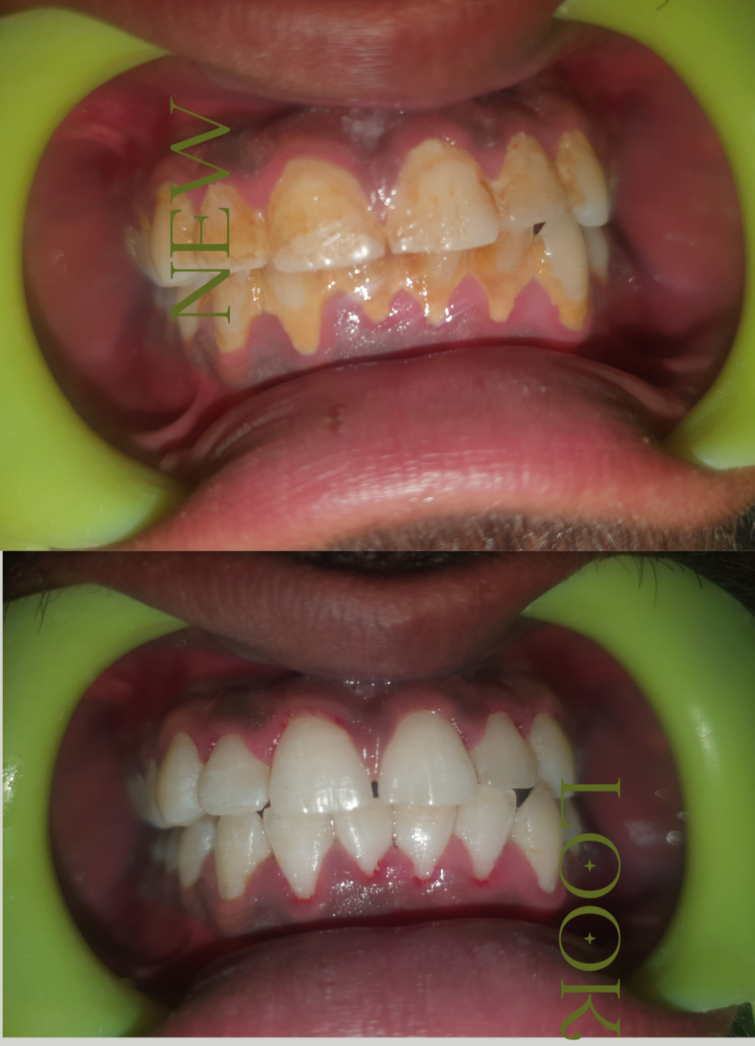 teeth cleaning-https://i-media.vyaparify.com/vcards/products/33698/20240322_184221.png Image