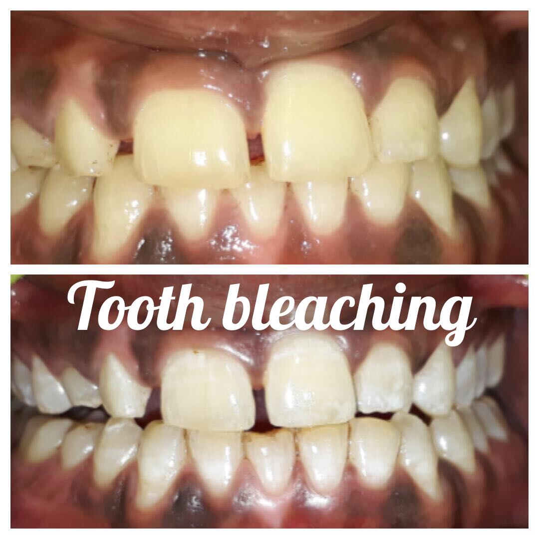 teeth bleaching-https://i-media.vyaparify.com/vcards/products/33701/IMG-20180307-WA0016.jpg Image