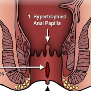 Hypertrophied Anal Papilla-https://i-media.vyaparify.com/vcards/products/55687/product_1721912232.png Image