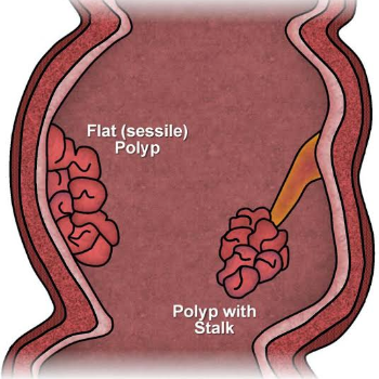 Anal Polyp-https://i-media.vyaparify.com/vcards/products/55688/product_1721912453.png Image
