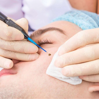 Skin Tag and Mole Removal Treatments | TEJ SKIN & COSMETIC CLINIC | Shop No 3, Arihant Apartment, Sinhgad Institute Road, Near Bank Of  Maharashtra , Ambegaon Budruk, Pune,         Maharashtra 411046,          India