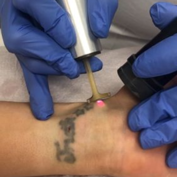 Tattoo Removal services | Needles Point Unisex Salon & Tattoo Studio | 7, Karve Nagar Rd, Near Sahid Mitra Mandal, Anand Vihar, Wanawari, Hingne Budrukh, Karve Nagar, Pune, Maharashtra 411052, India