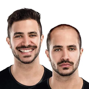 Non surgical hair replacements for male and female | Cdrreams | 565 Shivaji Nagar Near Congress Bhavan And Manapa Bhavan Pune Under Pmc Metro Station Pune 411005