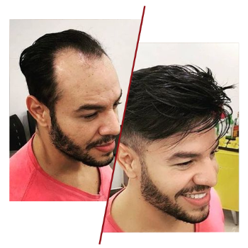 Hair systems service | Cdrreams | 565 Shivaji Nagar Near Congress Bhavan And Manapa Bhavan Pune Under Pmc Metro Station Pune 411005