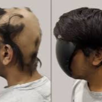 Alopecia wigs | Cdrreams | 565 Shivaji Nagar Near Congress Bhavan And Manapa Bhavan Pune Under Pmc Metro Station Pune 411005