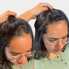 Hair patches | Cdrreams | 565 Shivaji Nagar Near Congress Bhavan And Manapa Bhavan Pune Under Pmc Metro Station Pune 411005