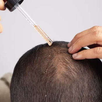 Hair Loss Treatment | Cdrreams | 565 Shivaji Nagar Near Congress Bhavan And Manapa Bhavan Pune Under Pmc Metro Station Pune 411005