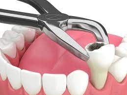 Extractions | Grace Dental Clinic | B 90 Greater Brajeshwari Piplyahana Behind Jmb Sweets