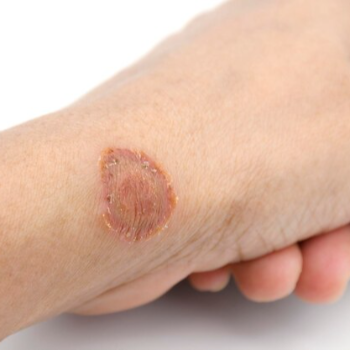 Skin Diseases & Dermatology Homeopathy – Aurum Homeopathy Clinic, Thane | Best Homeopathy Clinic In Thane, Mumbai | 8th Lane, Anand Nagar Rd, Kopri,Thane, Mumbai, Maharashtra 400603, India