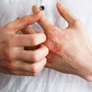 Autoimmune Diseases Treatment in Thane – Aurum Homeopathy Clinic | Best Homeopathy Clinic In Thane, Mumbai | 8th Lane, Anand Nagar Rd, Kopri,Thane, Mumbai, Maharashtra 400603, India