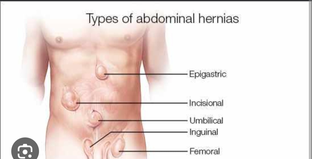 Hernia surgery | BRACES And Faces | 38 Brajeshwari Annex Near Ados Pados Apartment Bangali Squre Indore