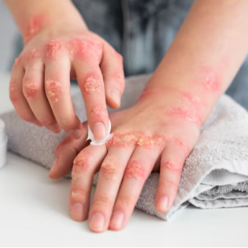 Psoriasis | Best Homeopathy Clinic In Thane, Mumbai | 8th Lane, Anand Nagar Rd, Kopri,Thane, Mumbai, Maharashtra 400603, India
