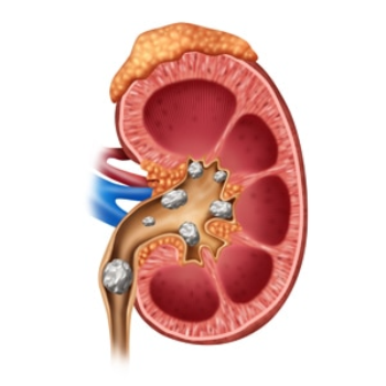 KIDNEY STONES | Ayush Speciality Clinic | Pune, Maharashtra 411060, India