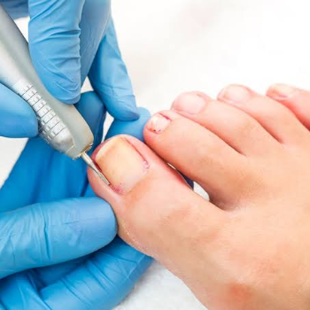 MINOR SURGERY -NAIL REMOVAL | Ayush Speciality Clinic | Pune, Maharashtra 411060, India
