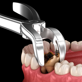 Extraction | Perfect Dental Clinic Warje | 1st-Swamikrupa Appt.Opp.Tapodham Bus Stop,Warje Malwadi Road,Warje Pune 411058                                                2nd - Shop No 06, Raj Complex Near Chinmay Hospital,Uttam Nagar,NDA Road,Pune 411023