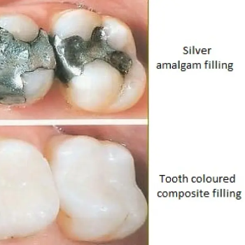 Cavity Filling | Perfect Dental Clinic Warje | 1st-Swamikrupa Appt.Opp.Tapodham Bus Stop,Warje Malwadi Road,Warje Pune 411058                                                2nd - Shop No 06, Raj Complex Near Chinmay Hospital,Uttam Nagar,NDA Road,Pune 411023