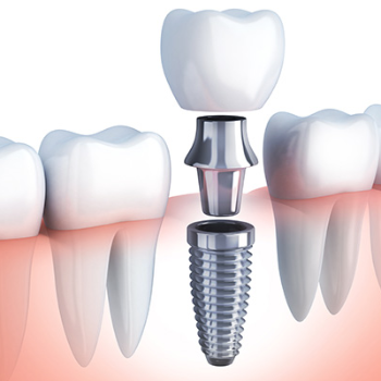 Dental IMplant | Perfect Dental Clinic Warje | 1st-Swamikrupa Appt.Opp.Tapodham Bus Stop,Warje Malwadi Road,Warje Pune 411058                                                2nd - Shop No 06, Raj Complex Near Chinmay Hospital,Uttam Nagar,NDA Road,Pune 411023