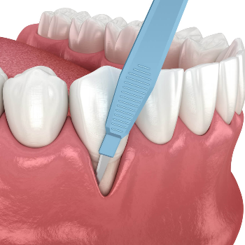 Periodontal Surgery | Perfect Dental Clinic Warje | 1st-Swamikrupa Appt.Opp.Tapodham Bus Stop,Warje Malwadi Road,Warje Pune 411058                                                2nd - Shop No 06, Raj Complex Near Chinmay Hospital,Uttam Nagar,NDA Road,Pune 411023