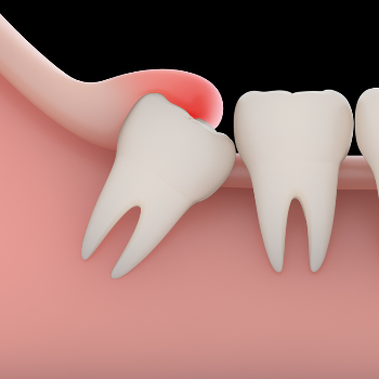 Minor Surgeries | Perfect Dental Clinic Warje | 1st-Swamikrupa Appt.Opp.Tapodham Bus Stop,Warje Malwadi Road,Warje Pune 411058                                                2nd - Shop No 06, Raj Complex Near Chinmay Hospital,Uttam Nagar,NDA Road,Pune 411023