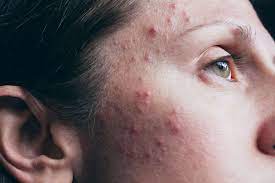 Acne | Dr.Preeti's Homeopathic Clinic | 302, Sanracha Avenues, Scheme 54 , Vijay Nagar