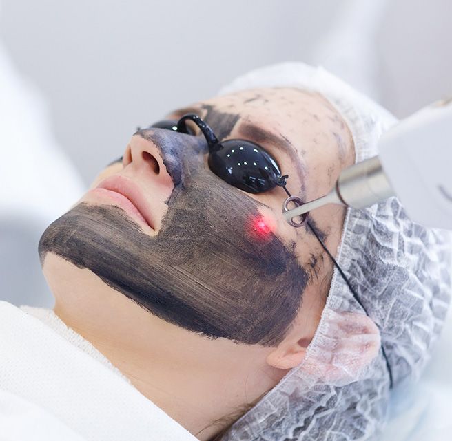 Carbon laser peel facial | Nuevo Care | 2/11 LIG, Near LIG Square In Indore