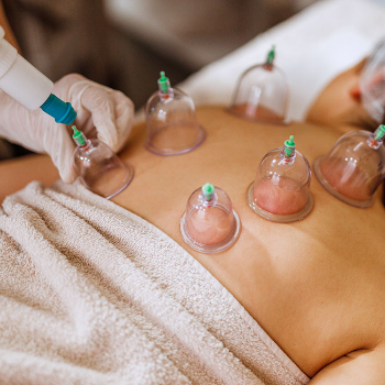 Cupping Therapy | SHIVANJALI ACCUPUNTURE & NATUROPATHY CLINIC | 106, Dhayari Phata Over Bridge, Wadgaon Budruk, Narhe, Pune, Maharashtra 411041, India