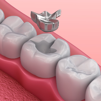 Dental Fillings | Clear Smile Dental Clinic | Expert Dental Care In Karve Nagar, Pune | Shop No.03, Vithai Plaza, Vadacha Stop, Opp. Vanadevi Temple, Mavale Basti, Hingne Budrukh, Karve Nagar, Pune, Maharashtra 411052, India