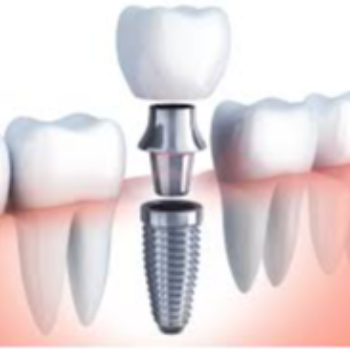 Implant Dentistry | Clear Smile Dental Clinic | Expert Dental Care In Karve Nagar, Pune | Shop No.03, Vithai Plaza, Vadacha Stop, Opp. Vanadevi Temple, Mavale Basti, Hingne Budrukh, Karve Nagar, Pune, Maharashtra 411052, India