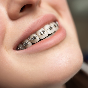 Orthodontics/Braces | Clear Smile Dental Clinic | Expert Dental Care In Karve Nagar, Pune | Shop No.03, Vithai Plaza, Vadacha Stop, Opp. Vanadevi Temple, Mavale Basti, Hingne Budrukh, Karve Nagar, Pune, Maharashtra 411052, India