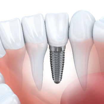 Painless Root Canal Treatment | Clear Smile Dental Clinic | Expert Dental Care In Karve Nagar, Pune | Shop No.03, Vithai Plaza, Vadacha Stop, Opp. Vanadevi Temple, Mavale Basti, Hingne Budrukh, Karve Nagar, Pune, Maharashtra 411052, India