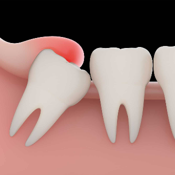 Painless Wisdom Tooth Removal | Clear Smile Dental Clinic | Expert Dental Care In Karve Nagar, Pune | Shop No.03, Vithai Plaza, Vadacha Stop, Opp. Vanadevi Temple, Mavale Basti, Hingne Budrukh, Karve Nagar, Pune, Maharashtra 411052, India