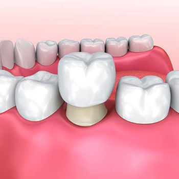 Dental Prosthesis (Crowns & Bridges) | Clear Smile Dental Clinic | Expert Dental Care In Karve Nagar, Pune | Shop No.03, Vithai Plaza, Vadacha Stop, Opp. Vanadevi Temple, Mavale Basti, Hingne Budrukh, Karve Nagar, Pune, Maharashtra 411052, India