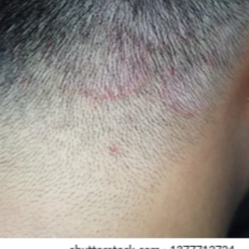 Fungal Infection Treatment | Sai Kesh Hair Oil | Jyotibanagar, Talwade