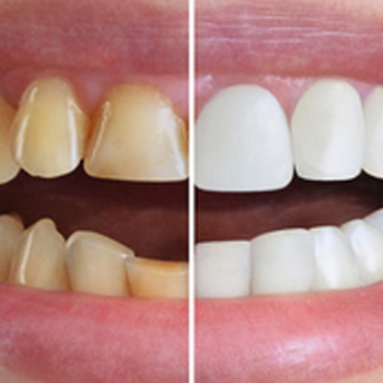 Full-mouth rehabilitation | Clear Smile Dental Clinic | Expert Dental Care In Karve Nagar, Pune | Shop No.03, Vithai Plaza, Vadacha Stop, Opp. Vanadevi Temple, Mavale Basti, Hingne Budrukh, Karve Nagar, Pune, Maharashtra 411052, India