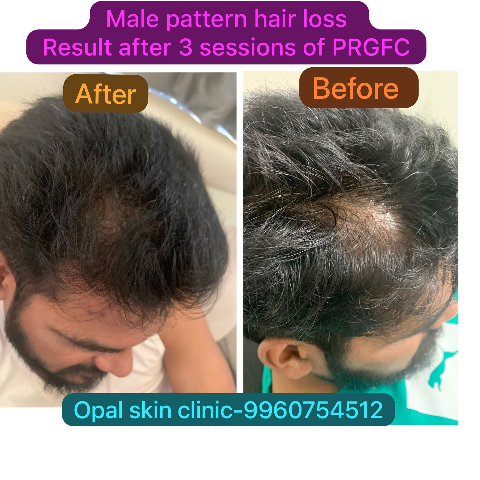 Male Pattern Hair Loss | Opal Skin Clinic | Sun City Rd, Sun City, Anand Nagar, Pune, Maharashtra 411051