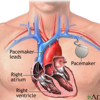 Pacemaker | Dr Swapnil Mohabansi Consultant Interventional Cardiologist | The Heart & Brain Clinic, Flat No. 103, 3rd Floor, Chamanlal Complex, Above Bank Of Maharashtra, Sinhgad Road, Pune