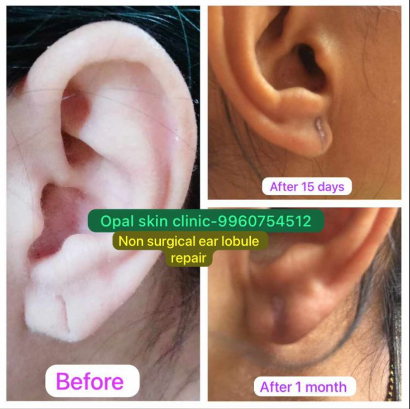 Non-Surgical Lobule Repair | Opal Skin Clinic | Sun City Rd, Sun City, Anand Nagar, Pune, Maharashtra 411051
